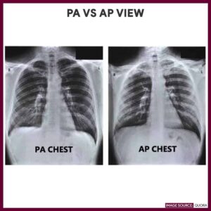 Chest Xray AP/PA