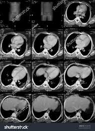 CT Pelvis - Contrasted