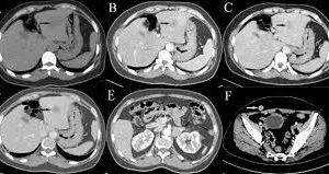 Abdominal CT - Plain