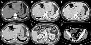 Abdominal CT - Plain
