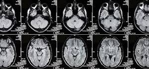 Brain CT - Contrasted