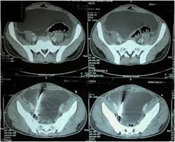 CT Pelvis - Plain