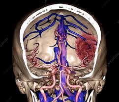 Brain CT Angio