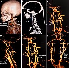 Carotid -Angio