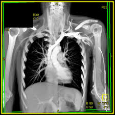 Chest CT - Angio