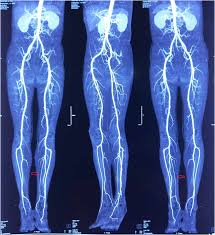 CT Limb Angio