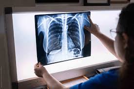 Chest CT - Contrasted