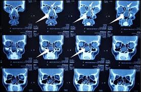 CT - PNS (Paranasal Sinuses) - Contrasted