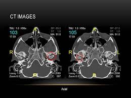 CT TMJ Computed Tomography) scan