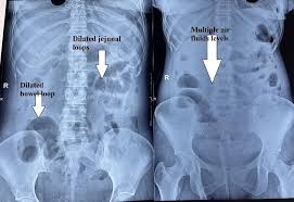 Abdominal Xray Erect/Supine
