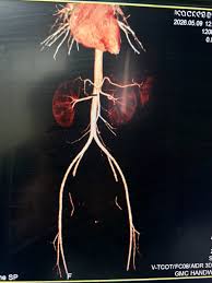 Abdominal CT - Angio