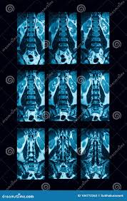 CT - Lumbar Spine