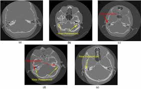 CT Mastoids - Contrast