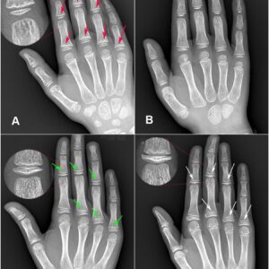 Hand / Fingers Xray