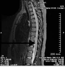 THORACIC SPINE MRI- WITH CONTRAST