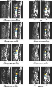 LUMBAR SPINE MRI WITH CONTRAST
