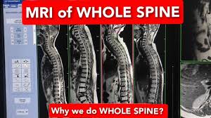 WHOLE SPINE  WITHOUT CONTRAST