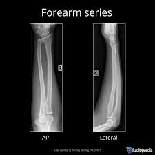 Forearm Xray AP-LAT