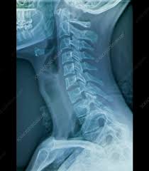 Neck Xray