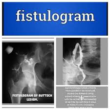 Fistulogram (Special Investigations)