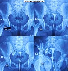HSG (Hysterosalpingogram)