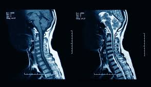 NECK MRI CONTRASTED
