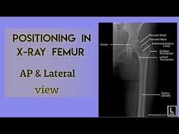 Femur Xray - AP/LAT