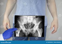 Hip Joints Xray