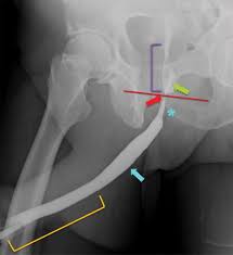 CUG (Cystourethrogram)