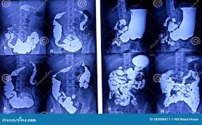 Barium Meal follow through