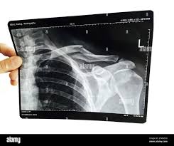 Clavical Xray